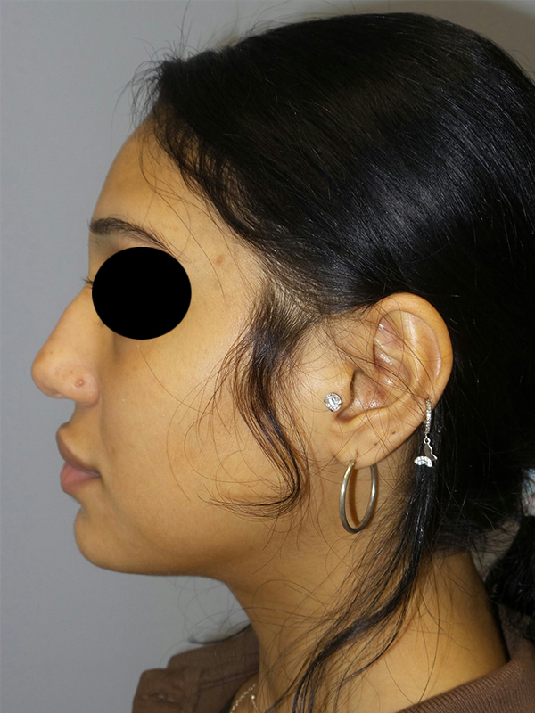 Rhinoplasty Before and After 51 | Sanjay Grover MD FACS