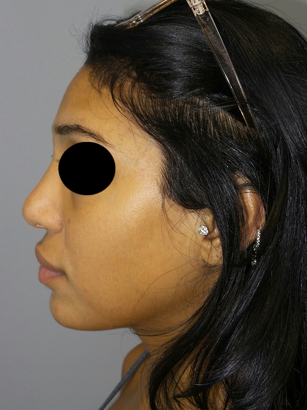 Rhinoplasty Before and After 51 | Grover Aesthetics