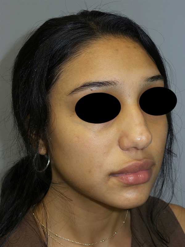 Rhinoplasty Before and After 51 | Grover Aesthetics