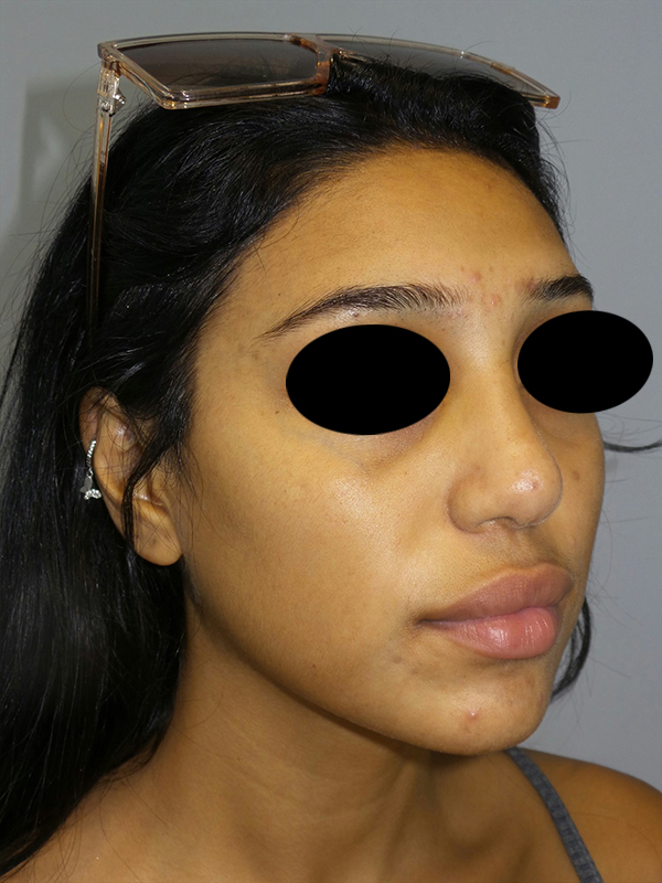 Rhinoplasty Before and After 51 | Grover Aesthetics