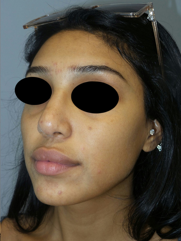 Rhinoplasty Before and After 51 | Grover Aesthetics