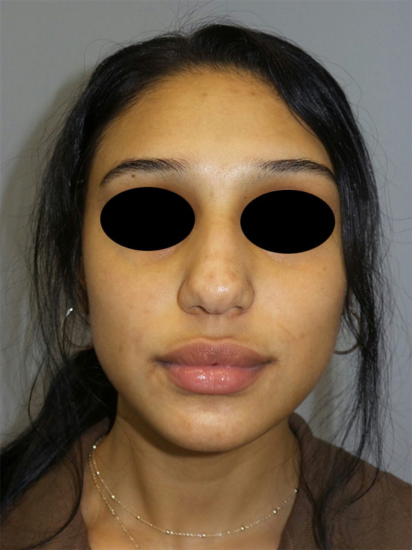 Rhinoplasty Before and After 51 | Grover Aesthetics