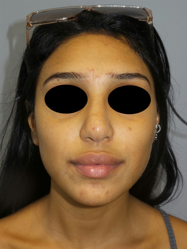 Rhinoplasty Before and After 51 | Grover Aesthetics