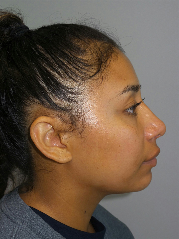 Rhinoplasty Before and After | Grover Aesthetics
