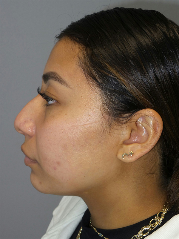 Rhinoplasty Before and After 52 | Sanjay Grover MD FACS