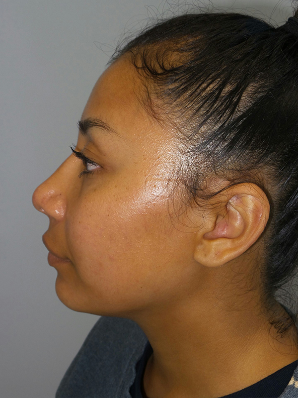 Rhinoplasty Before and After 52 | Sanjay Grover MD FACS