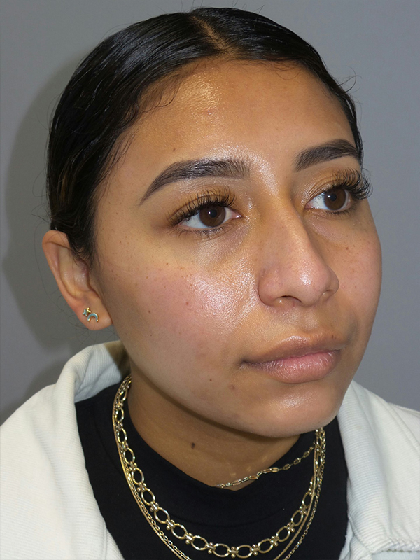 Rhinoplasty Before and After 52 | Grover Aesthetics