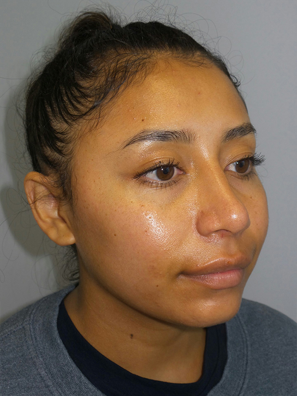 Rhinoplasty Before and After 52 | Grover Aesthetics