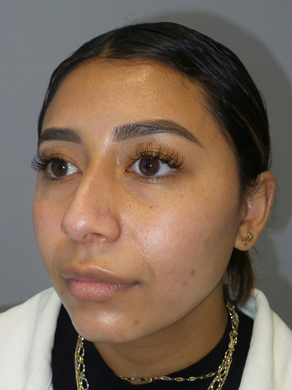 Rhinoplasty Before and After 52 | Grover Aesthetics