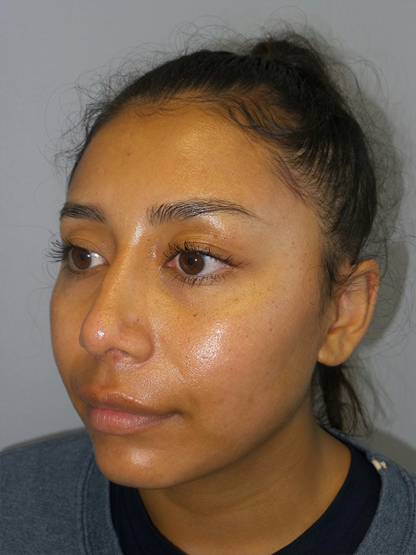 Rhinoplasty Before and After 52 | Grover Aesthetics