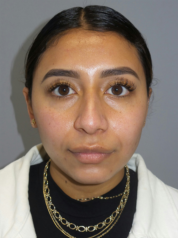 Rhinoplasty Before and After 52 | Grover Aesthetics