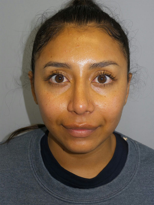 Rhinoplasty Before and After 52 | Grover Aesthetics