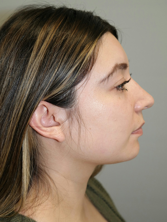 Rhinoplasty Before and After | Grover Aesthetics