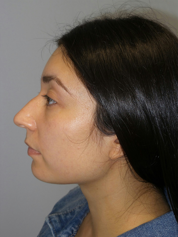 Rhinoplasty Before and After 54 | Grover Aesthetics
