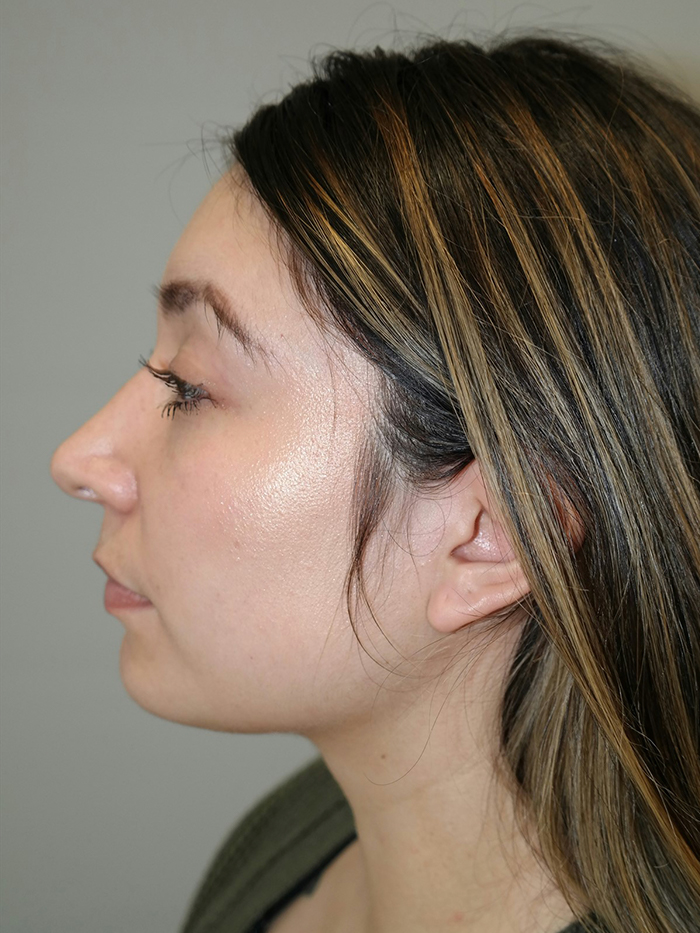 Rhinoplasty Before and After 54 | Grover Aesthetics