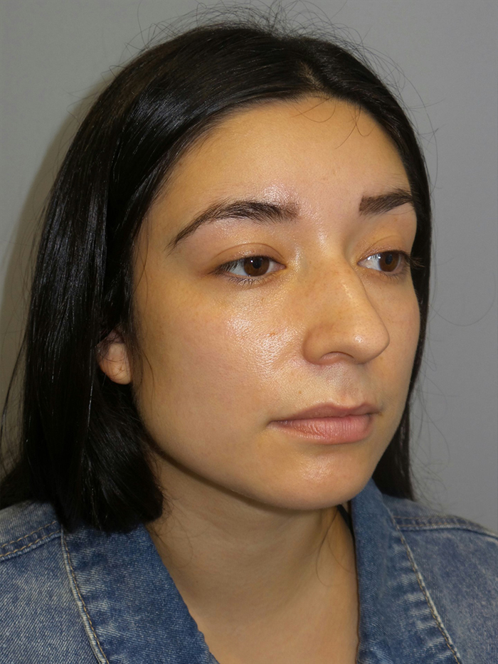 Rhinoplasty Before and After 54 | Grover Aesthetics