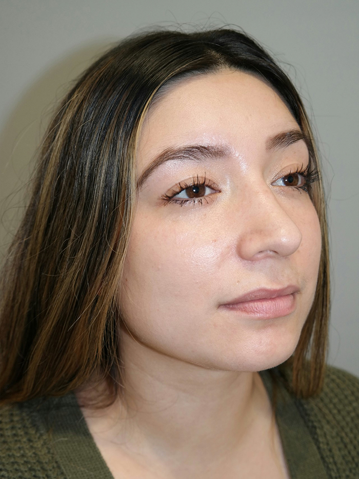 Rhinoplasty Before and After 54 | Grover Aesthetics