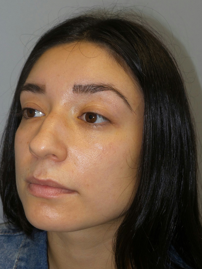 Rhinoplasty Before and After 54 | Grover Aesthetics