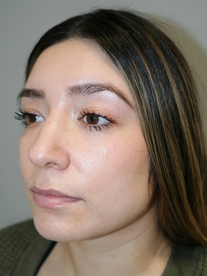 Rhinoplasty Before and After 54 | Grover Aesthetics
