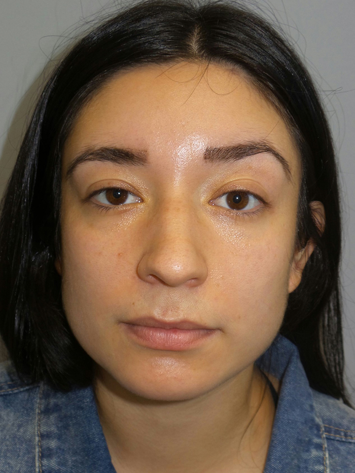 Rhinoplasty Before and After 54 | Grover Aesthetics