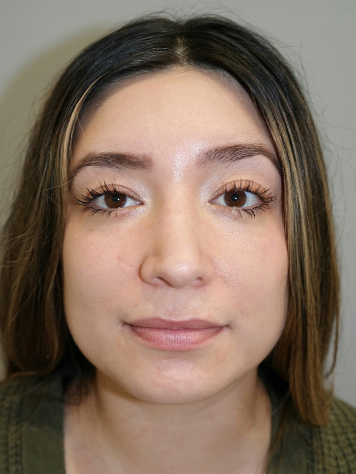 Rhinoplasty Before and After 54 | Grover Aesthetics