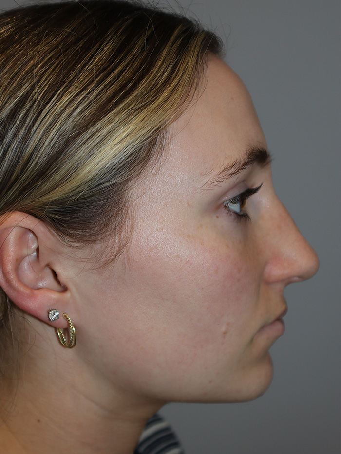 Rhinoplasty Before and After | Grover Aesthetics