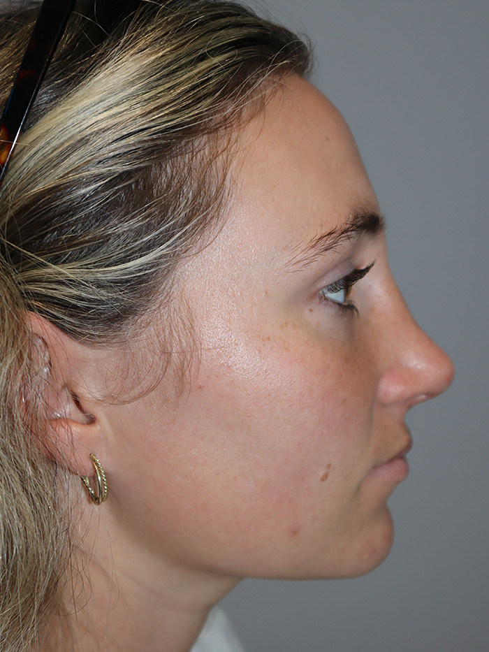 Rhinoplasty Before and After | Grover Aesthetics