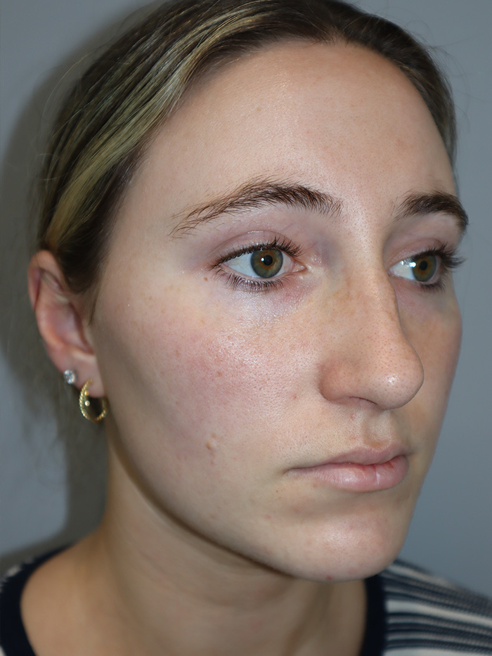 Rhinoplasty Before and After 56 | Grover Aesthetics