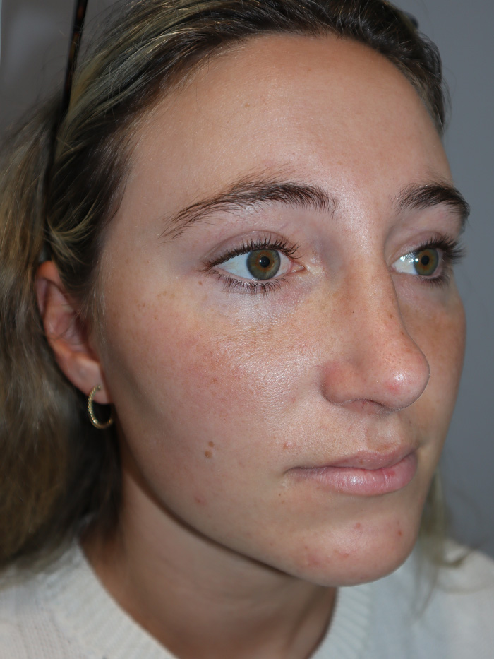 Rhinoplasty Before and After 56 | Grover Aesthetics
