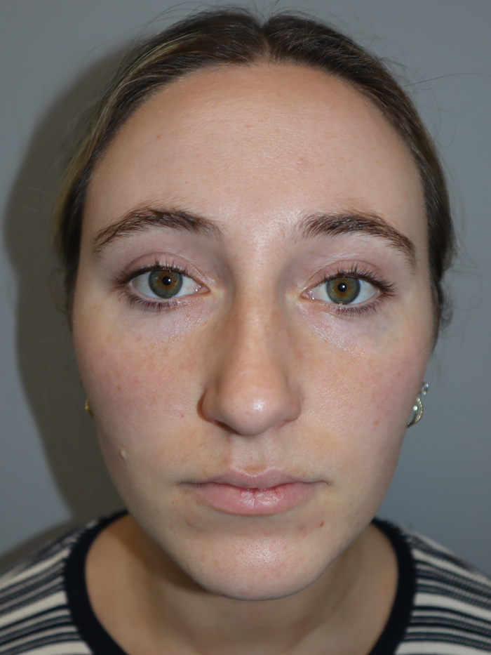 Rhinoplasty Before and After 56 | Grover Aesthetics
