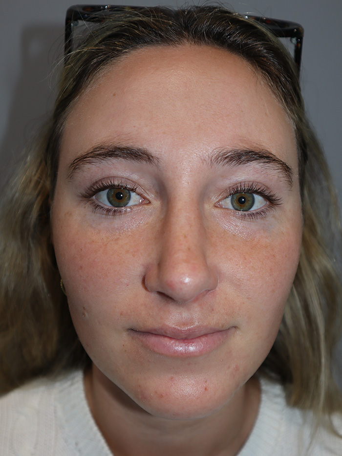 Rhinoplasty Before and After 56 | Grover Aesthetics