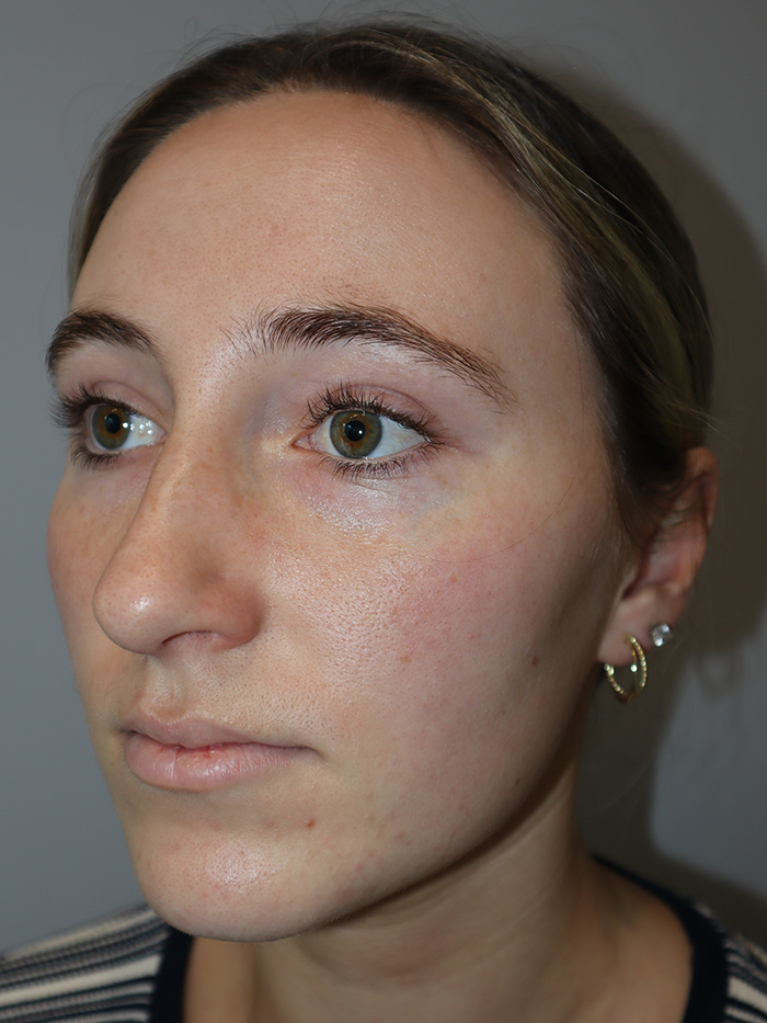 Rhinoplasty Before and After 56 | Grover Aesthetics