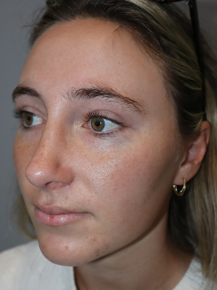 Rhinoplasty Before and After 56 | Grover Aesthetics