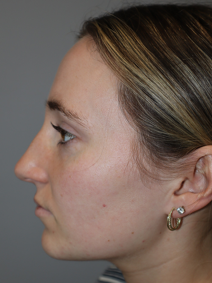 Rhinoplasty Before and After 56 | Grover Aesthetics
