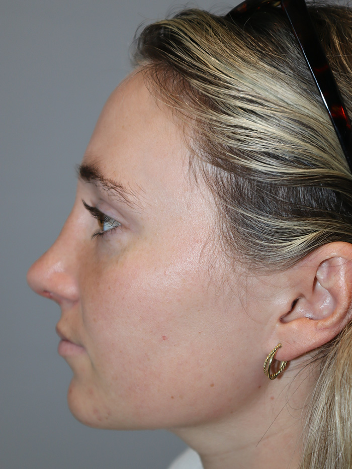 Rhinoplasty Before and After 56 | Grover Aesthetics