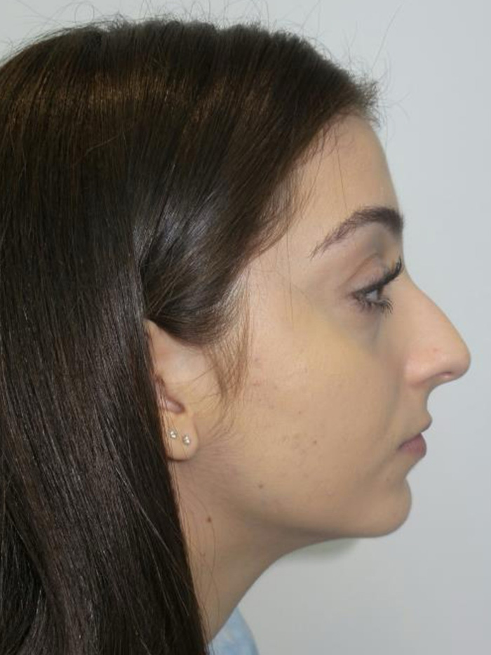 Rhinoplasty Before and After | Grover Aesthetics