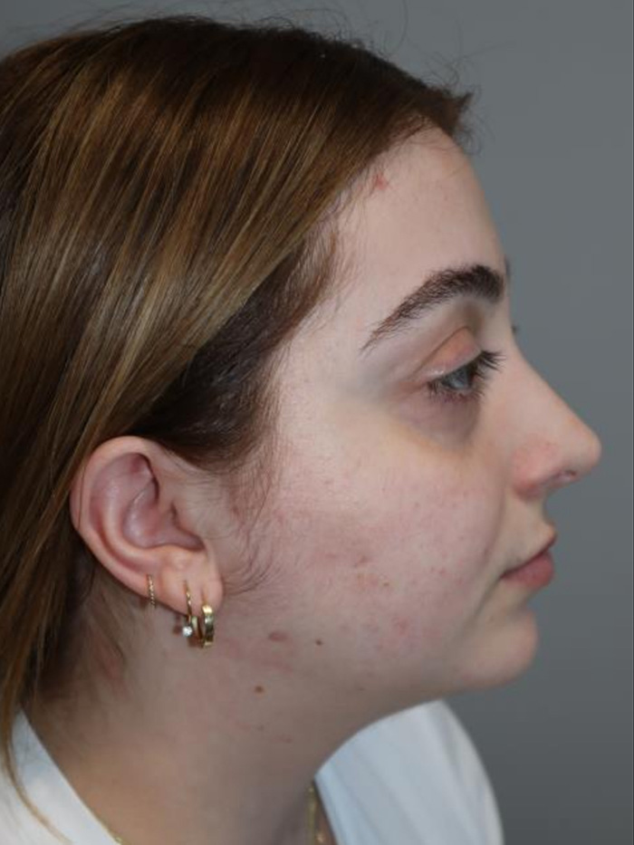 Rhinoplasty Before and After | Grover Aesthetics