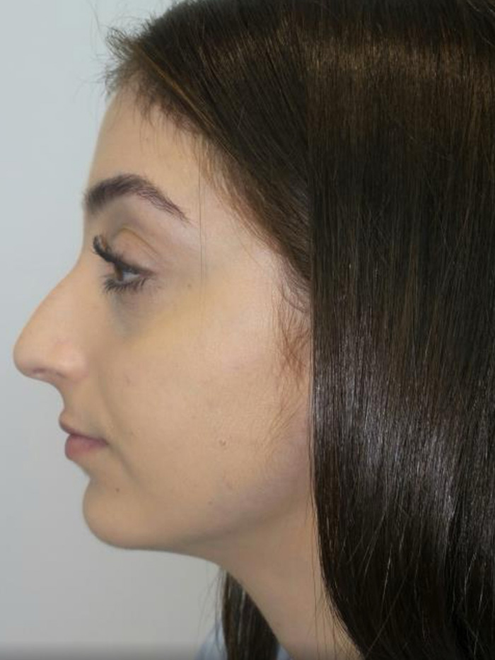 Rhinoplasty Before and After 57 | Grover Aesthetics
