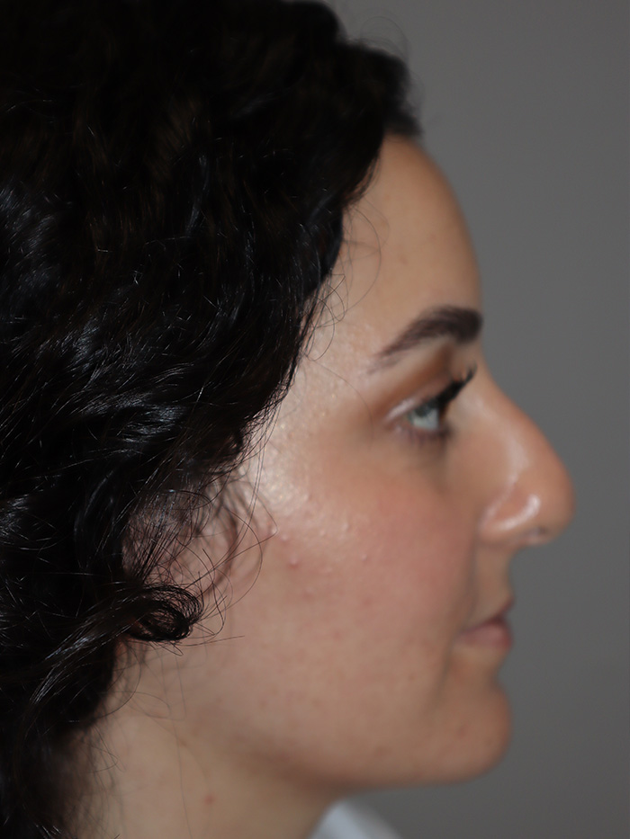 Rhinoplasty Before and After | Grover Aesthetics