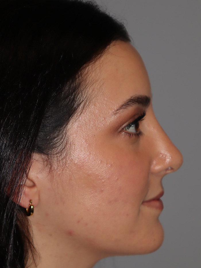 Rhinoplasty Before and After | Grover Aesthetics