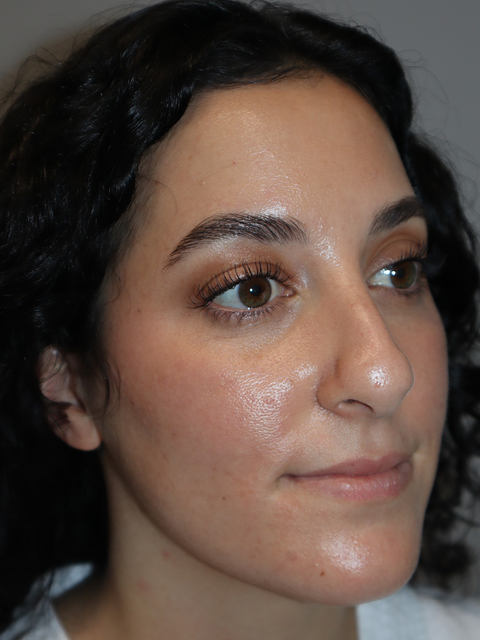 Rhinoplasty Before and After 58 | Grover Aesthetics