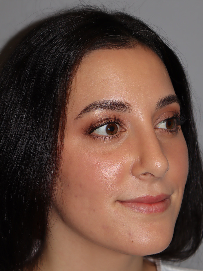 Rhinoplasty Before and After 58 | Grover Aesthetics