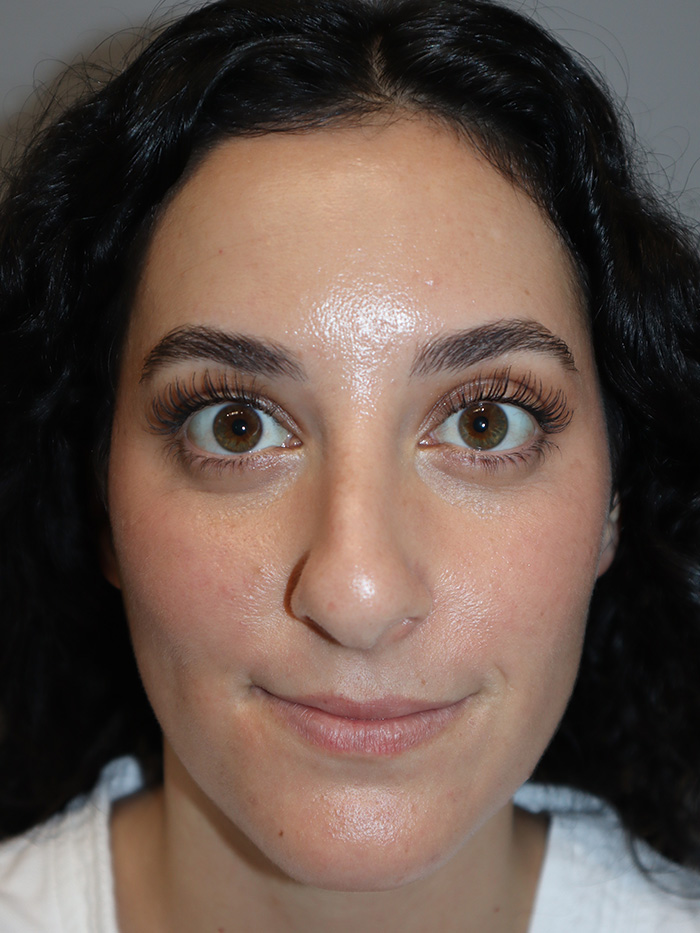 Rhinoplasty Before and After 58 | Grover Aesthetics