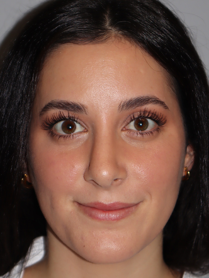 Rhinoplasty Before and After 58 | Grover Aesthetics