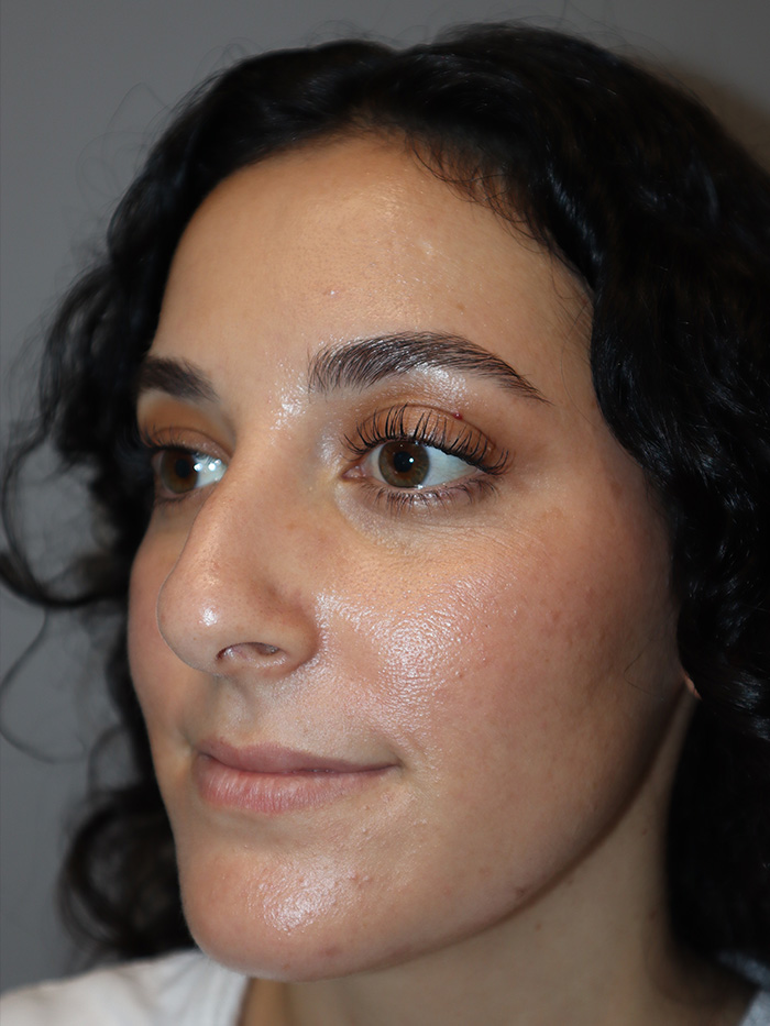 Rhinoplasty Before and After 58 | Grover Aesthetics