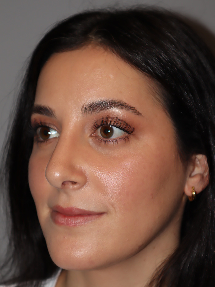 Rhinoplasty Before and After 58 | Grover Aesthetics