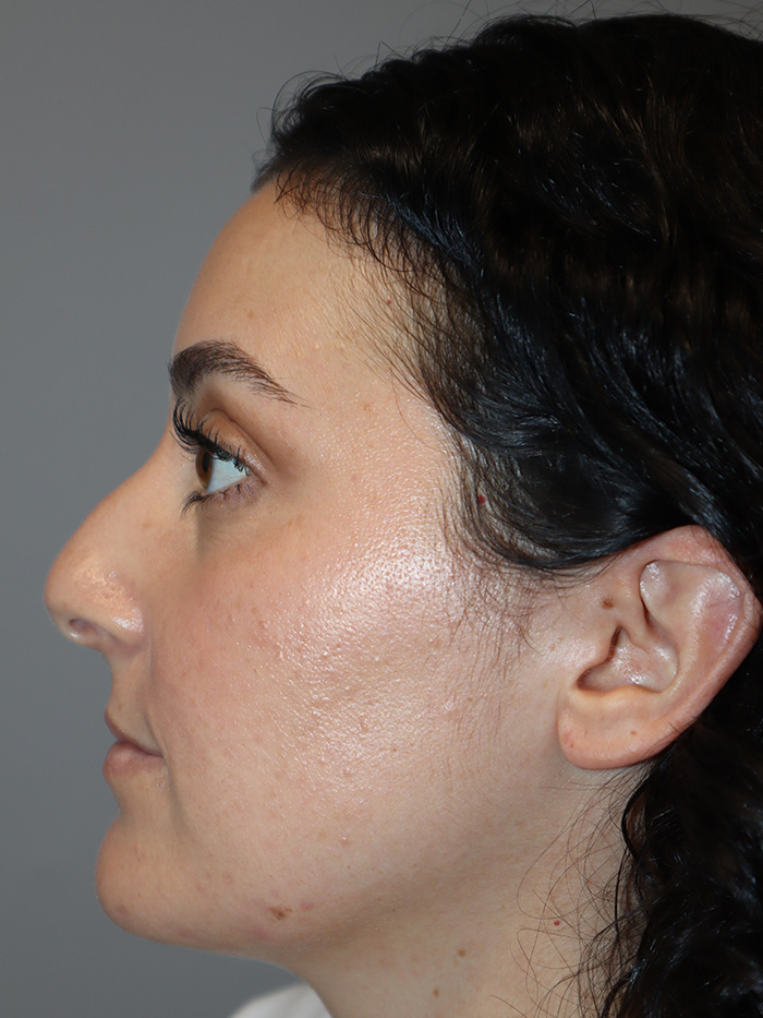 Rhinoplasty Before and After 58 | Grover Aesthetics