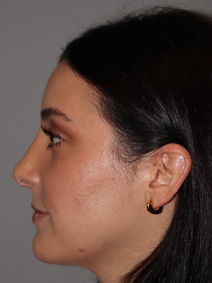 Rhinoplasty Before and After 58 | Grover Aesthetics