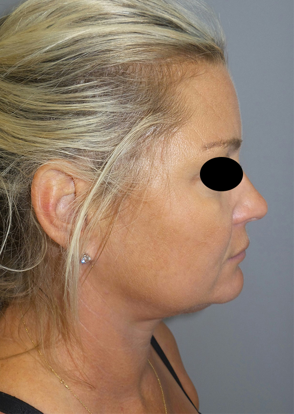 Submental Liposuction Before and After | Grover Aesthetics