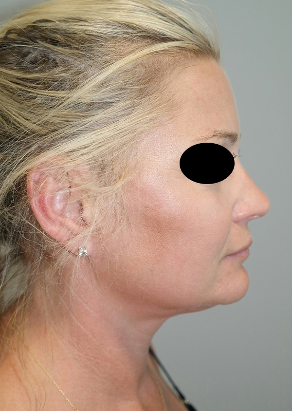 Submental Liposuction Before and After | Grover Aesthetics